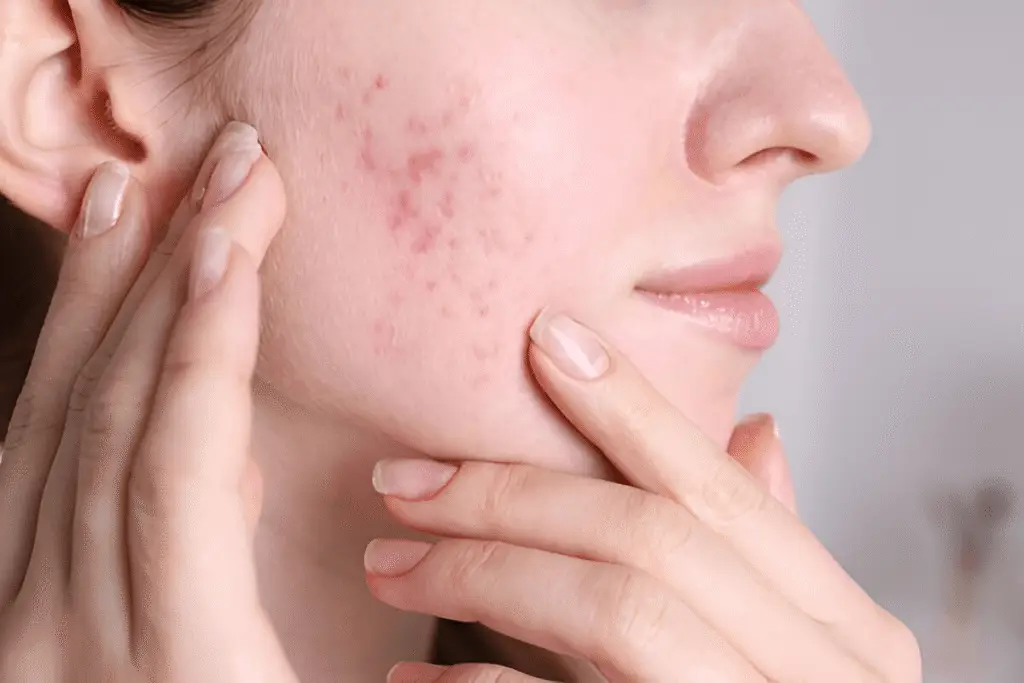 Beer Triggers Skin Problems You May Blame on Weather